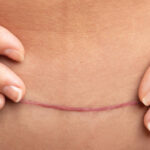 Close up image of a scar after a C-Section procedure.